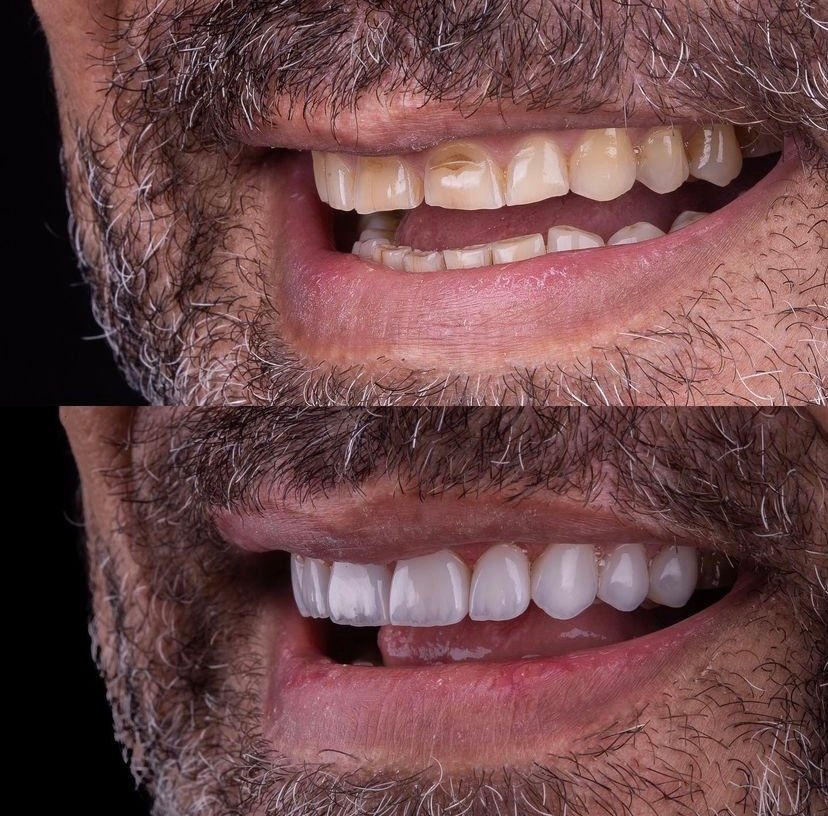 Facetas dentárias realizadas pela doutora Cristiane Borba