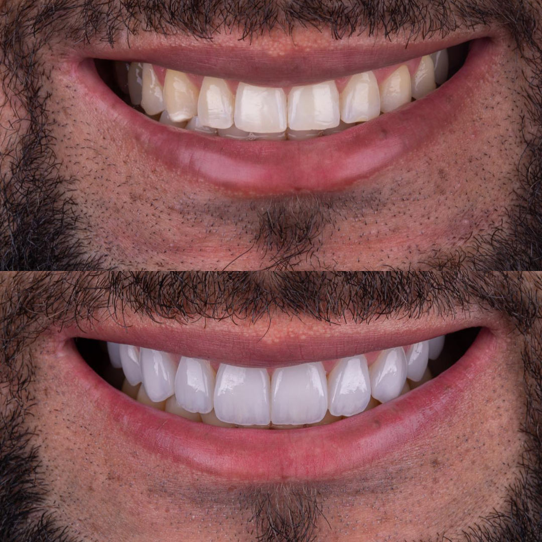 Facetas em Resina realizadas pela Dra.Cristiane Borba