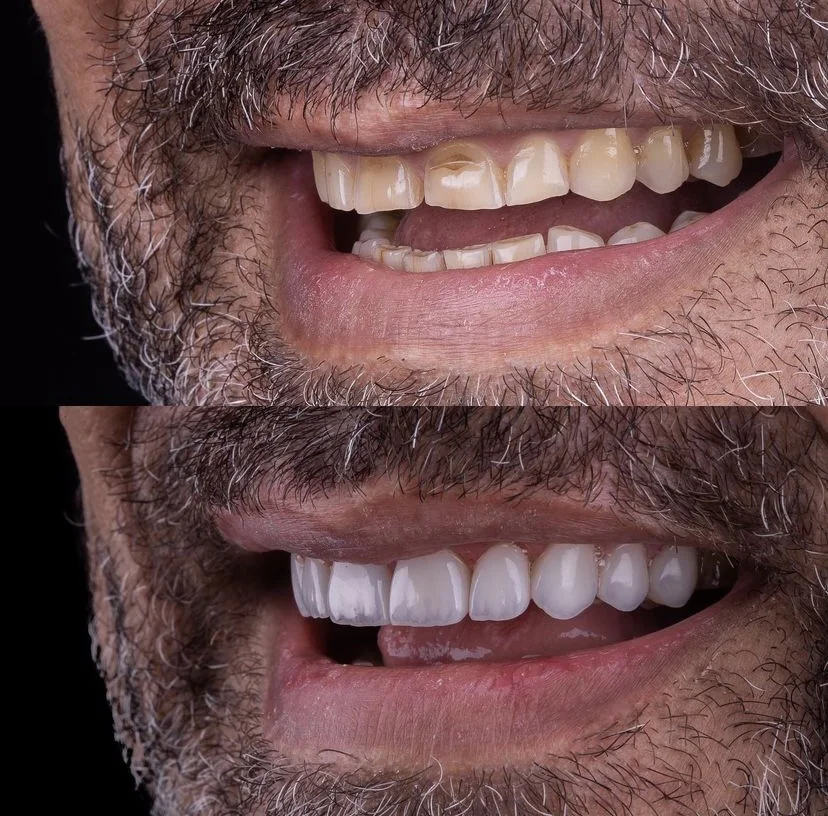 Facetas dentárias realizadas pela doutora Cristiane Borba
